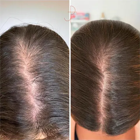 Antes e depois de uma cliente da Consulta de Tricologia Integrativa